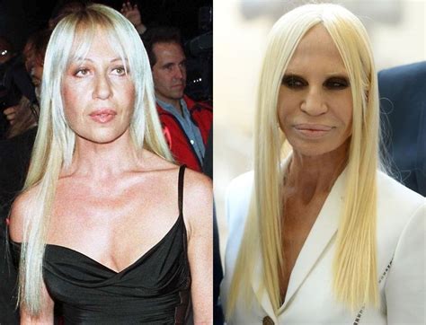 chirurgia plastica donatella versace|donatella versace before.